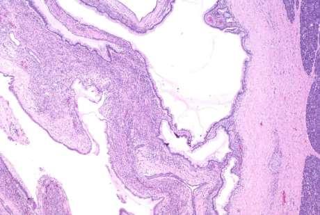 Mucinous Cystic Neoplasm Not associated with the pancreatic ducts