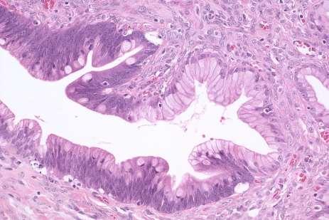 ovarian-like stroma required Atypia may be very heterogeneous;