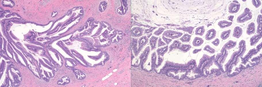 IPMN Variously papillary mucinous epithelium of variable cell type and heterogenous