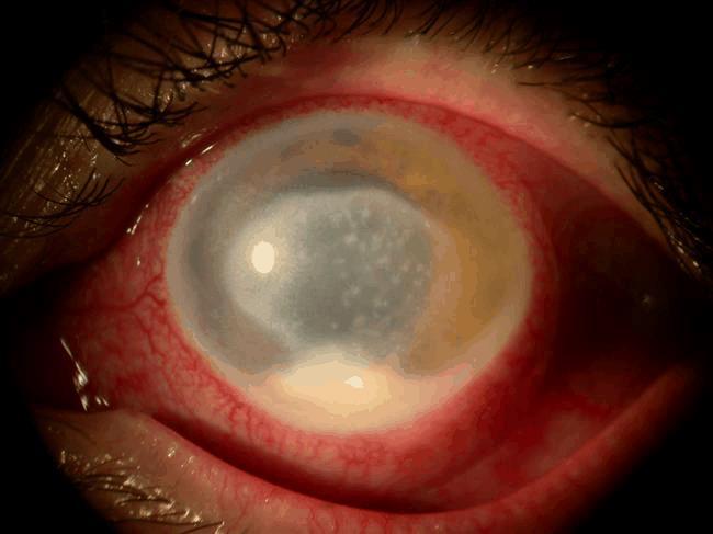 Acanthamoebic keratitis Keratitis Begins with a foreign-body sensation followed by