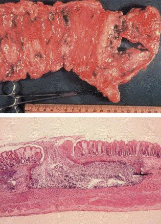 Disease Amebic colitis -> amebic dysentery (Intestinal amoebiasis) Hematogenous spread to