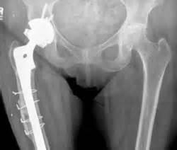 dislocation Knee immobilizer Abduction brace Anterior