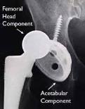 Larger femoral head Constrained liner Abductor repair