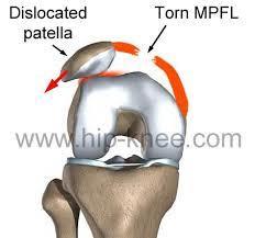 Intra-articular Injuries Articular cartilage Pediatrics Osteochondritis dissecans Patellar dislocations with chondral shear injury