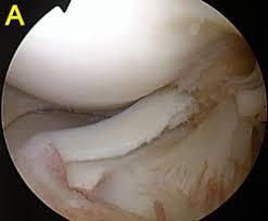 Meniscal Injuries Meniscus tears will not heal with observation Inability for stabilization of the tissue Relatively
