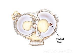 Radial Tears Commonly treated with partial meniscectomy Detrimental effects on the contact mechanics of the knee Bedi et