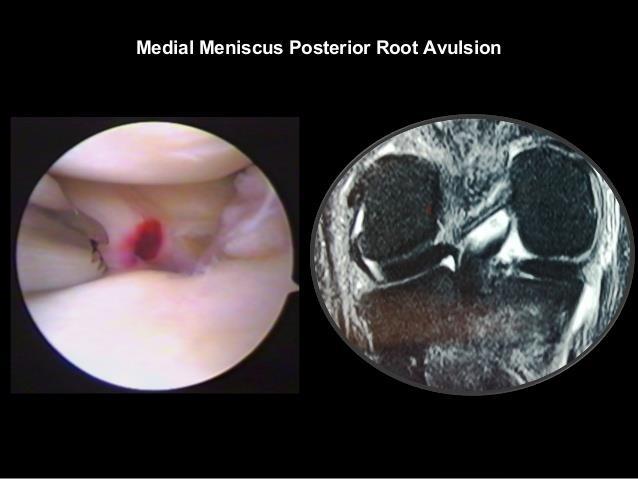Root Tears Results in extruded meniscus Yamagami et al, Knee 2017 Severe loss of meniscal function Bhatia et al, AJSM 2014 Risk for progressive OA Han