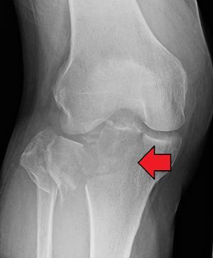 the physis Tibial eminence fractures Adults Tibial