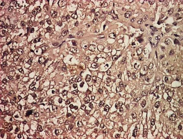 Figura 63. Carcinom endometroid G3, imunomarcaj N-caderina, ob.
