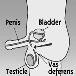 Vasectomy Male Sterilization