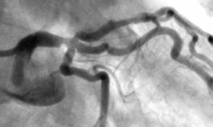 Secondary End Point left main area analysis Angiographic restenosis at