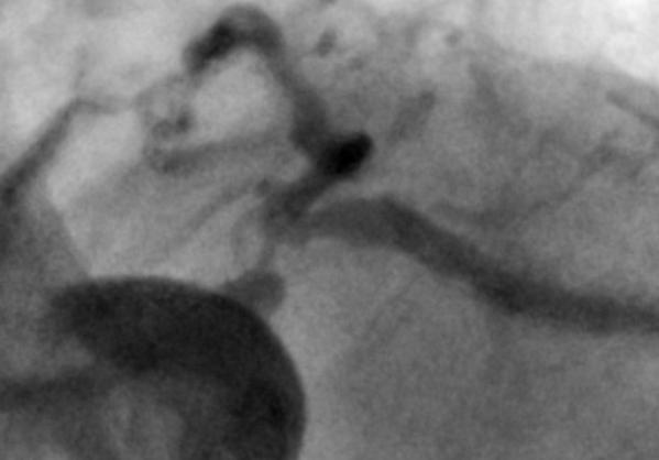 in the area from left main ostium to 5-mm proximal segments of LAD, LCx