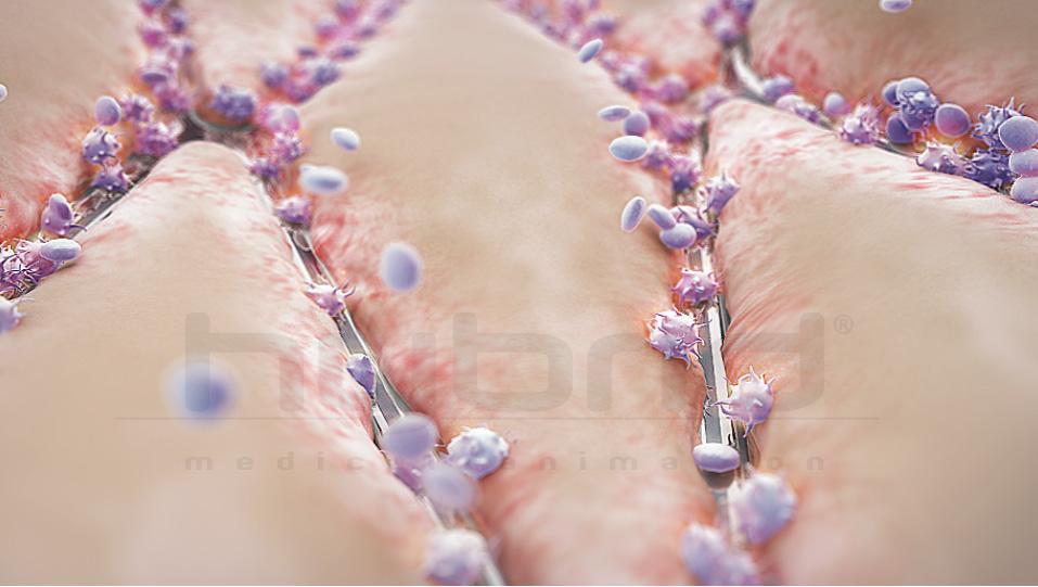 the stented segment requires protection from stent thrombosis that occurs as a result of