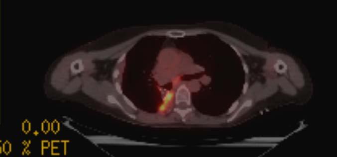 Metastatic progression in the lung and abdominal lymph nodes (3/14) De novo resistance, alternative options