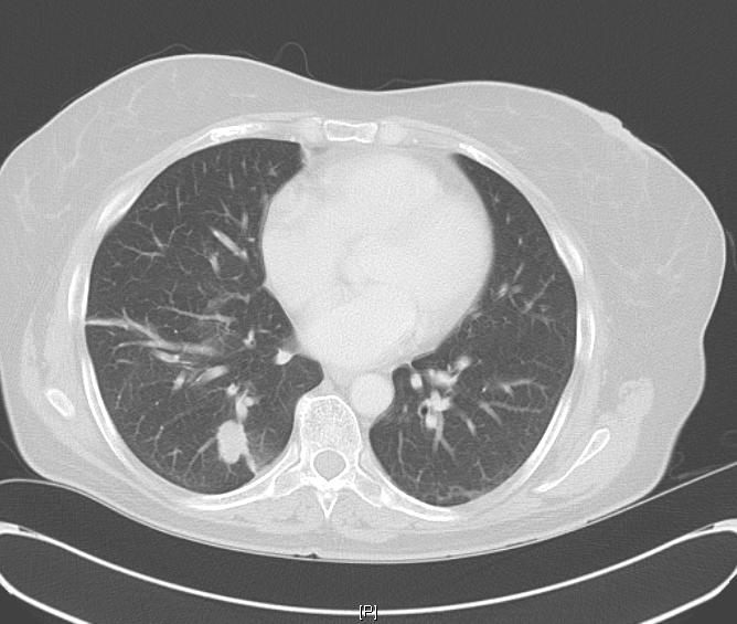 ALK acquired resistance Right lung biopsy demonstrated moderately differentiated adenocarcinoma, TTF-1 diffuse nuclear positivity, CK20 negative, CK7 positive, Right supraclavicular lymph node