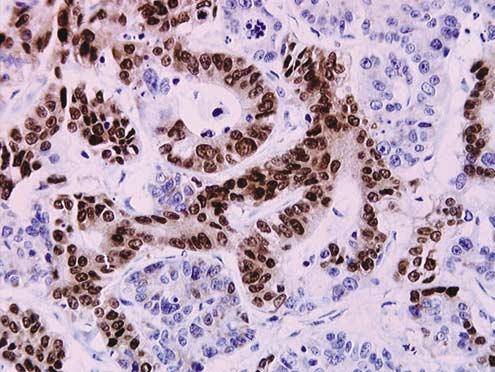 Sensitivity/specificity TTF-1 1374 Figure 4 Colon carcinoma: Novocastra antibody clone SPT24. Figure 5 Primary lung adenocarcinoma: Novocastra antibody clone SPT24.