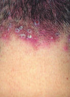 Illustrated quizzes on problems seen in everyday practice Case 1 A 23-year-old man presented with an itchy rash over the posterior part of his neck. 2. What is the cause? 3. What is the treatment? 1. Folliculitis.