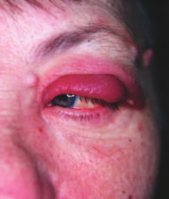 Case 2 A 67-year-old woman presented with a red, swollen, tender left upper eyelid. 2. What investigations would you perform? 1. Cellulitis of the upper eyelid. 2. Culture of skin swabs, aspiration of tissue fluid, or skin biopsy specimens can be performed, but rarely result in a culture of the causative organism (Streptococcus pyogenes).