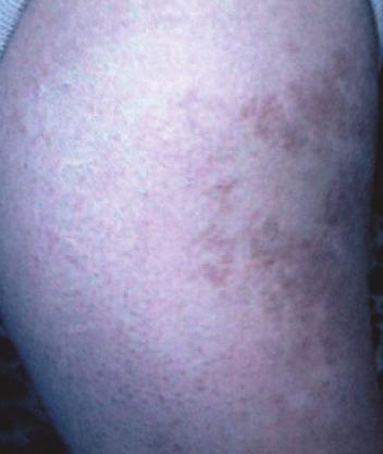 Case 4 A 43-year-old woman is concerned about a pigmented lesion on her right upper arm that has been present since she was 15 years old. 2.