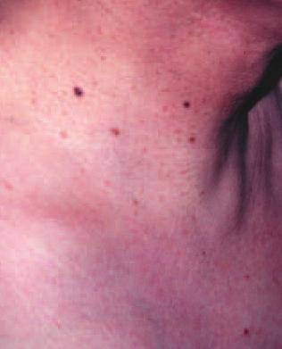 Case 6 A 55-year-old man presented with a 12-month history of multiple pigmented lesions over his neck. 2.