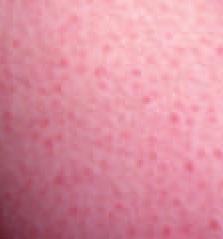 Case 8 This teenage girl presents with an asymptomatic rash on her upper arms and lateral thighs, which she finds cosmetically upsetting. Question Answer 1. Keratosis pilaris.