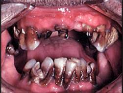Poor hygiene ( meth mouth ) Who makes the diagnosis?