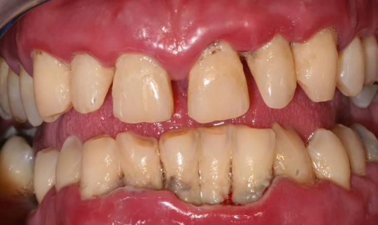 Iatrogenic Component: Xerostomia Decreased saliva promotes caries and periodontal disease Many medications reduce salivary flow steroids