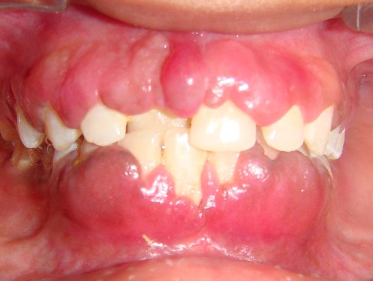 Enlarged Gum Tissue The exact mechanism of gingival hyperplastic reaction is unknown.