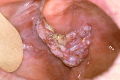 30,000 oral cancers diagnosed annually