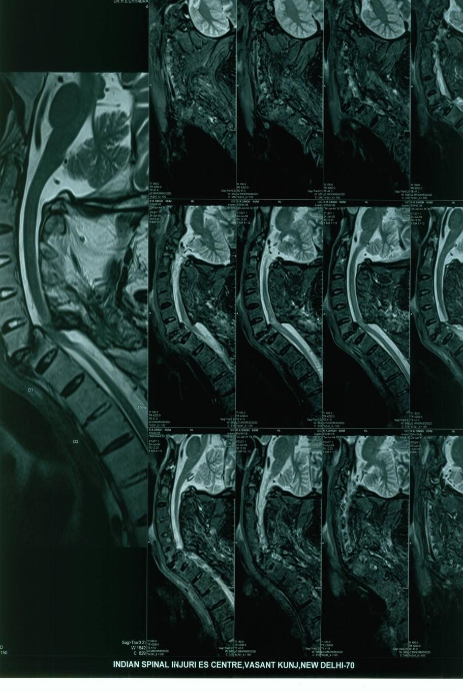 INVESTIGATIONS MRI : C6 & C7 HAVE MALUNITED IN A