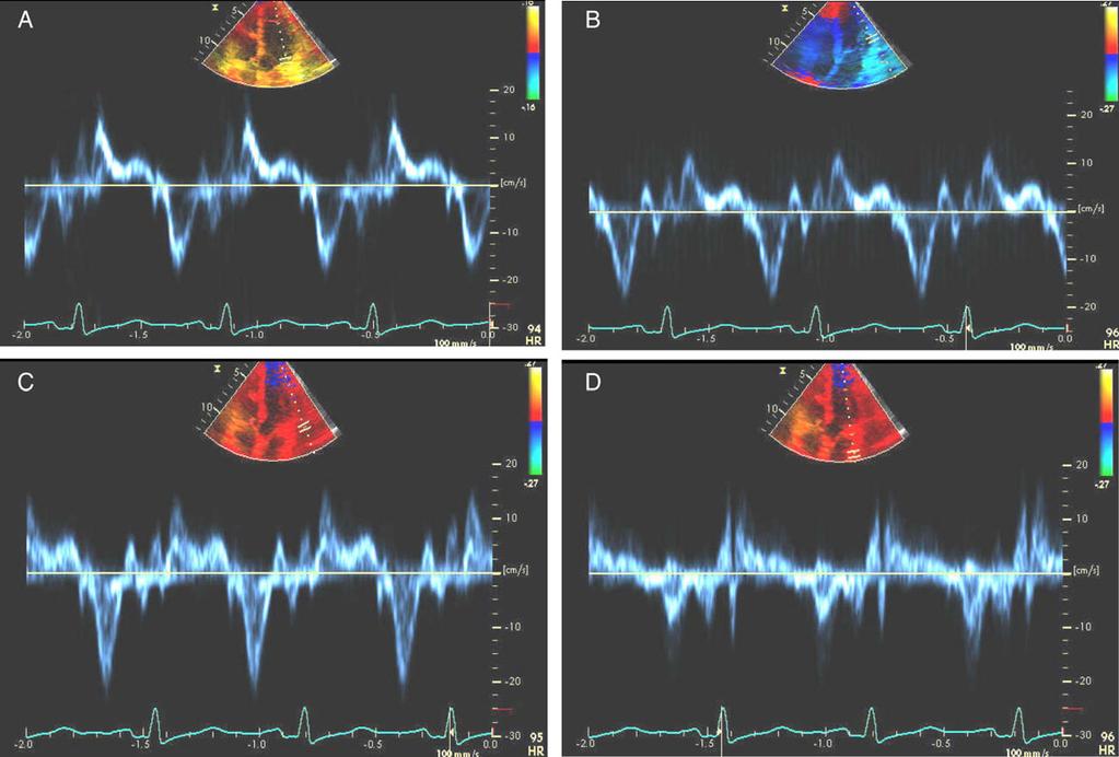 Page 10 of 40 S. F. Nagueh et al. Figure 3 Tissue Doppler recordings of lateral mitral annular velocities. In (A), Doppler sample volume is located in part in LV cavity.