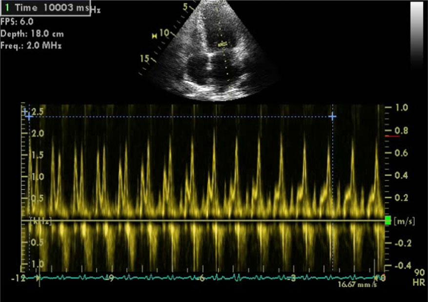 Page 12 of 40 S. F. Nagueh et al. Figure 5 Valsalva maneuver in a patient with grade II diastolic dysfunction. At baseline, E/A ratio is 1.3 (left) and decreases to 0.