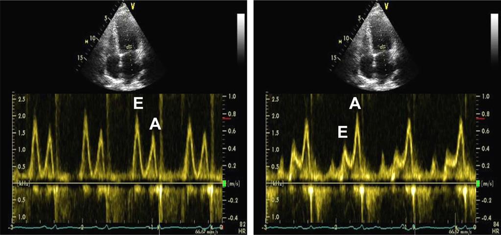 Figure 6 Continuous recording of mitral inflow during standardized Valsalva maneuver for 10 sec showing the decrease in E/A ratio with straining, which is consistent with elevated LV filling