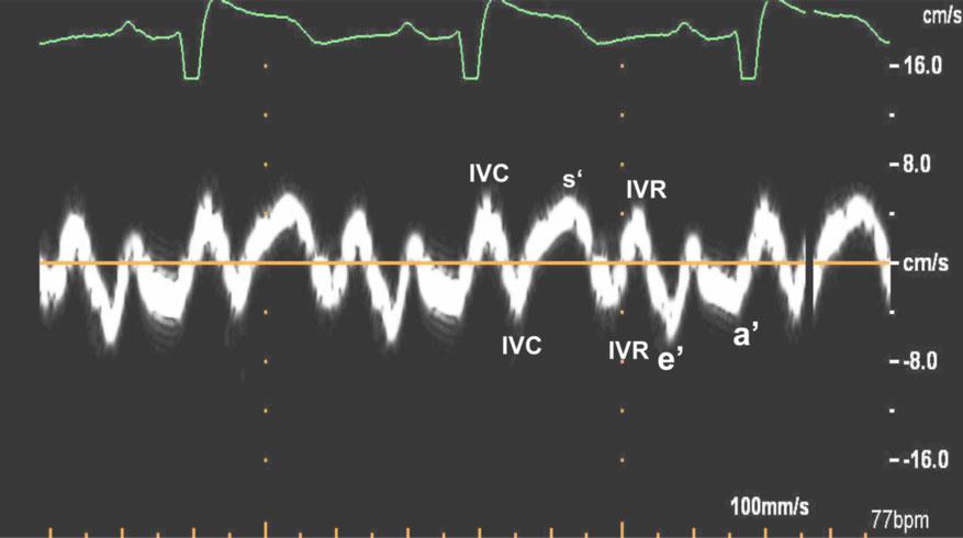 Recommendations for the Evaluation of Left Ventricular Diastolic Function by Echocardiography Page 17 of 40 Figure 10 Mitral inflow (left) and pulmonary venous flow (right) from a patient with HFrEF.