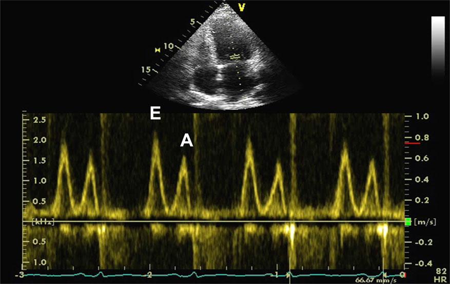 Page 18 of 40 S. F. Nagueh et al. Figure 12 (Left) Mitral inflow from a patient with HFpEF. Mitral inflow pattern is consistent with elevated LV filling pressures.