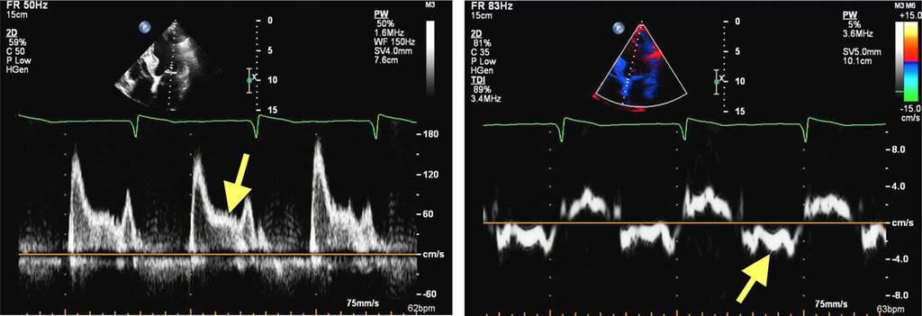 Recommendations for the Evaluation of Left Ventricular Diastolic Function by Echocardiography Page 19 of 40 Figure 14 Mitral inflow (left) and IVRT (right) from another patient with HFpEF and heart