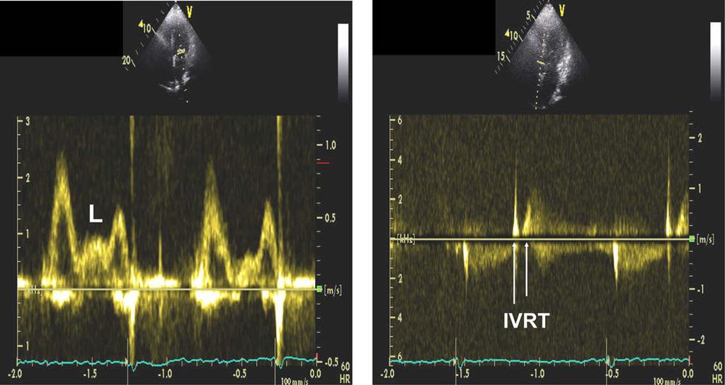The arrows in the right panel point to IVRT between aortic valve closure and mitral valve opening. IVRT was short at 48 msec consistent with increased LAP.