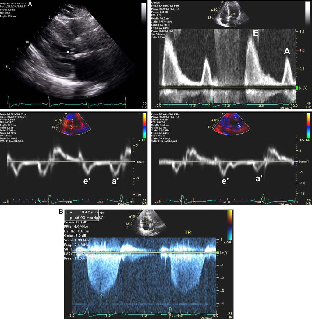 Recommendations for the Evaluation of Left Ventricular Diastolic Function by Echocardiography Page 23 of 40 Figure 18 (A) Two-dimensional imaging of a patient with HCM (left top) in the parasternal