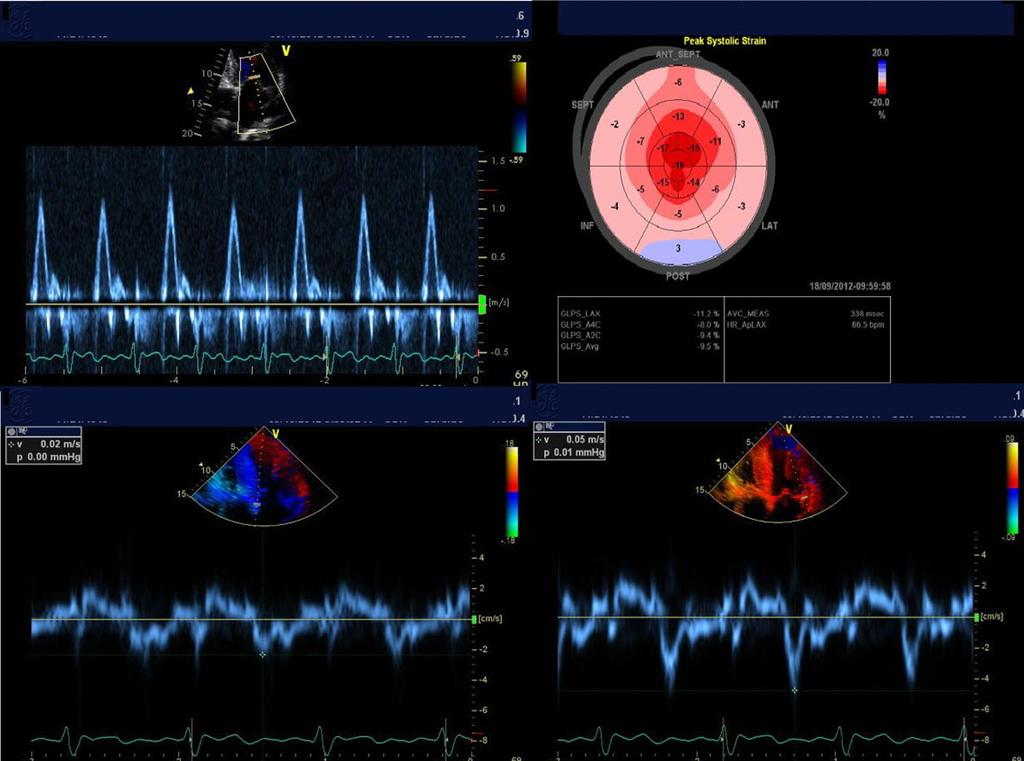 Recommendations for the Evaluation of Left Ventricular Diastolic Function by Echocardiography Page 25 of 40 Figure 20 Restrictive physiology in advanced cardiac amyloidosis showing (left upper)