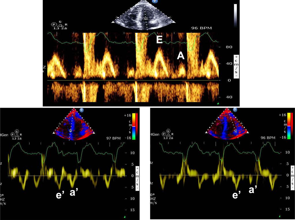 Recommendations for the Evaluation of Left Ventricular Diastolic Function by Echocardiography Page 27 of 40 Figure 22 Mitral inflow (top) and septal (bottom left) and lateral (bottom right) mitral
