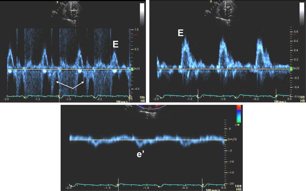 transplantation patient in a ventricular paced rhythm and with severely depressed LV systolic function and diastolic dysfunction (bottom: markedly reduced septal e velocity at 2 3 cm/sec).