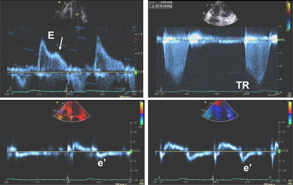 Recommendations for the Evaluation of Left Ventricular Diastolic Function by Echocardiography Page 29 of 40 Figure 25 Doppler recordings from a patient with AF and elevated LV filling pressures.