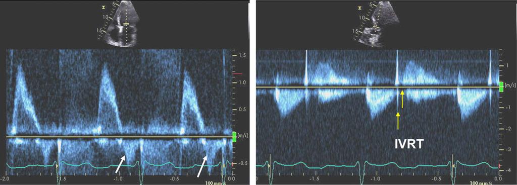 TR peak velocity (top right)is 3.2 m/sec, corresponding to RV to right atrial pressure gradient of 42 mm Hg and thus increased PASP.
