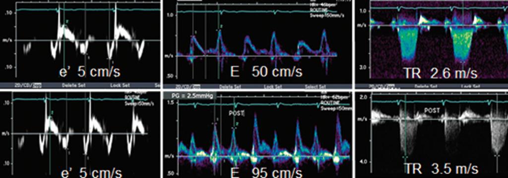 Recommendations for the Evaluation of Left Ventricular Diastolic Function by Echocardiography Page 31 of 40 Figure 29 Mitral septal annulus (left), mitral inflow (middle), and TR velocity (right) at