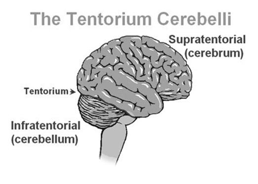 CS Extension: Brain & Cerebral Meninges 400 500 510 Image source: Wikipedia CS Extension: Brain & Cerebral Meninges Code 600 Tumor invades: Bone (skull); major blood vessels; meninges; nerves, NOS;