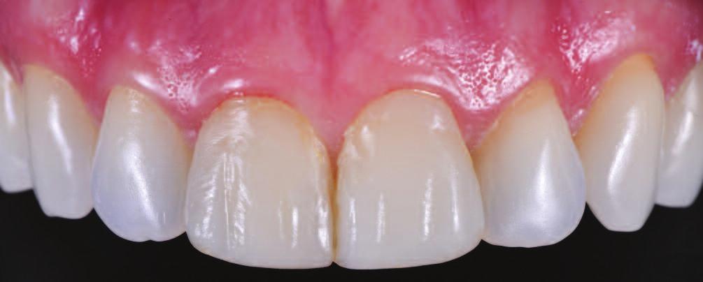 C L I N I C A L Fig. 2: One year later when the patient returned to the practice, the teeth showed unsatisfactory composite veneers. Fig. 3: The veneers were removed and the teeth were transilluminated to identify any composite residue.