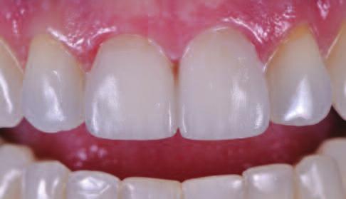 In the present case, an additional hurdle had to be overcome: Any composite material that might have remained on the tooth structure had to be clearly identified and carefully removed without