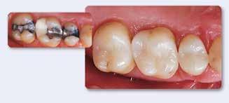 It can be used for the fabrication of all-ceramic restorations for individual teeth, such as inlays, onlays,