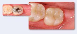 However, the teeth have to be prepared carefully beforehand to establish the prerequisites needed for the correct