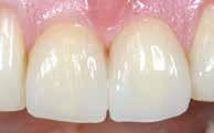 Wiedhahn, Germany EXTERNAL SHADING The outer surfaces of crowns and veneers are